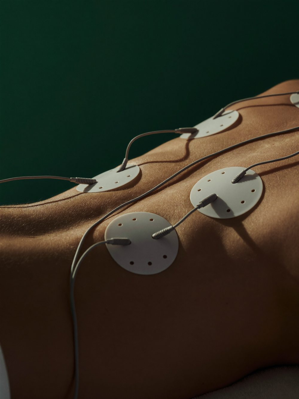 Electrical stimulation therapy electrode pads placed on a patient's back
